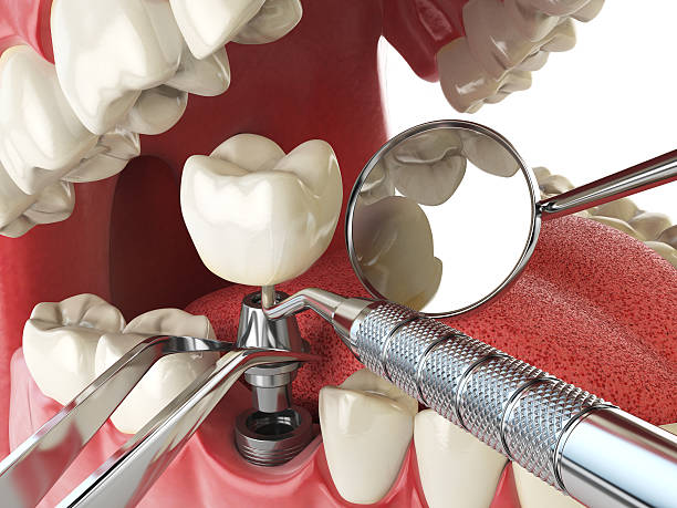 Best Chipped Tooth Repair Near Me  in White River Junction, VT